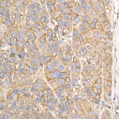 Immunohistochemistry-Paraffin: Sodium Potassium ATPase Alpha 1 Antibody [NBP2-95255] - Immunohistochemistry of paraffin-embedded human liver cancer using Sodium Potassium ATPase Alpha 1 Rabbit pAb (NBP2-95255) at dilution of 1:50 (40x lens). Perform high pressure antigen retrieval with 10 mM citrate buffer pH 6.0 before commencing with IHC staining protocol.