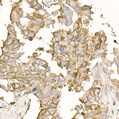 Immunohistochemistry-Paraffin: Sodium Potassium ATPase Alpha 1 Antibody [NBP2-95255] - Immunohistochemistry of paraffin-embedded human lung cancer using Sodium Potassium ATPase Alpha 1 Rabbit pAb (NBP2-95255) at dilution of 1:50 (40x lens). Perform high pressure antigen retrieval with 10 mM citrate buffer pH 6.0 before commencing with IHC staining protocol.