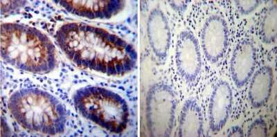 Immunohistochemistry-Paraffin: Sodium Potassium ATPase Alpha 3 Antibody (XVIF9-G10) [NB300-540] - Both normal and cancer biopsies of deparaffinized Human colon tissues.