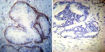 Immunohistochemistry-Paraffin: Sodium Potassium ATPase Alpha 3 Antibody (XVIF9-G10) [NB300-540] - Both normal and cancer biopsies of deparaffinized Human prostate carcinoma tissues.