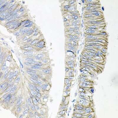 Immunohistochemistry-Paraffin: Sodium Potassium ATPase Beta 1 Antibody [NBP2-95093] - Paraffin-embedded human colon carcinoma using Sodium Potassium ATPase Beta 1 .