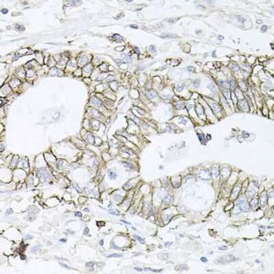 Immunohistochemistry-Paraffin: Sodium Potassium ATPase Beta 1 Antibody [NBP2-95093] - Paraffin-embedded human gastric cancer using Sodium Potassium ATPase Beta 1 .