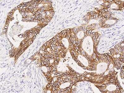 Immunohistochemistry-Paraffin: Sodium Potassium ATPase Beta 1 Antibody [NBP3-00261] - Immunochemical staining of human Sodium Potassium ATPase Beta 1 in human colon carcinoma with rabbit polyclonal antibody (1:2000, formalin-fixed paraffin embedded sections).