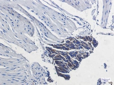 Immunohistochemistry-Paraffin: Sodium Potassium ATPase Beta 1 Antibody (S02-8B6) [NBP3-20085] - Immunohistochemistry of Sodium Potassium ATPase Beta 1 in paraffin-embedded Human colon cancer tissue using NBP3-20085 at dilution 1/20