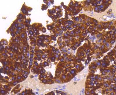 Immunohistochemistry-Paraffin: Sonic Hedgehog/Shh Antibody (SC05-28) [NBP2-67603] - Analysis of paraffin-embedded human liver cancer tissue using anti-Sonic Hedgehog Protein antibody. Counter stained with hematoxylin.