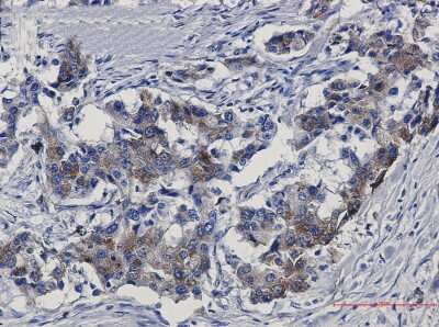 Immunohistochemistry-Paraffin: Sortilin Antibody (S02-6B4) [NBP3-15095] - Immunohistochemistry of Sortilin in paraffin-embedded Human lung cancer tissue using Sortilin Rabbit mAb at dilution 1/50