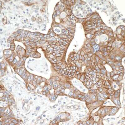 Immunohistochemistry: Spectrin beta 2 Antibody [NB100-40828] - Detection of human SPTBN1 by immunohistochemistry. Sample: FFPE section of human ovarian carcinoma. Antibody: Affinity purified rabbit anti- SPTBN1 (NB100-40828). Detection: DAB