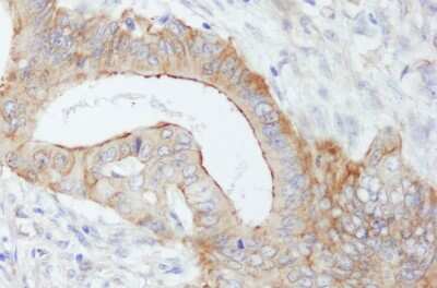 <b>Independent Antibodies Validation and Biological Strategies Validation.</b>Immunohistochemistry-Paraffin: Spectrin beta 2 Antibody [NB100-40829] - Section of human colon carcinoma. Antibody: Affinity purified rabbit anti- SPTBN1 used at a dilution of 1:1,000 (0.2ug/ml). Detection: DAB