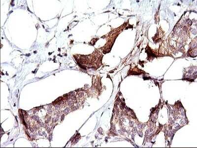 Immunohistochemistry: Sphingosine Kinase 1/SPHK1 Antibody (OTI1A6) - Azide and BSA Free [NBP2-74332] - Analysis of Adenocarcinoma of Human breast tissue. (Heat-induced epitope retrieval by 1 mM EDTA in 10mM Tris, pH8.5, 120C for 3min)