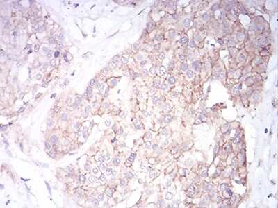 Immunohistochemistry-Paraffin: Sphingosine Kinase 2/SPHK2 Antibody (3C8D3) [NBP2-52566] - Analysis of ovarian cancer tissues using SK2 mouse mAb with DAB staining.
