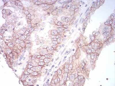 Immunohistochemistry-Paraffin: Sphingosine Kinase 2/SPHK2 Antibody (3C8D3) [NBP2-52566] - Analysis of endometrial cancer tissues using SK2 mouse mAb with DAB staining.