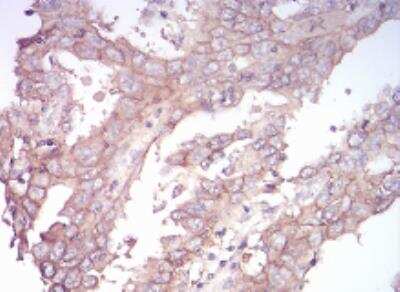Immunohistochemistry-Paraffin: Sphingosine Kinase 2/SPHK2 Antibody (9C5E1) [NBP2-52567] - Analysis of paraffin-embedded endometrial cancer tissues using SK2 mouse mAb with DAB staining.