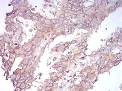 Immunohistochemistry-Paraffin: Sphingosine Kinase 2/SPHK2 Antibody (9C5E1) [NBP2-52567] - Analysis of  endometrial cancer tissues using SK2 mouse mAb with DAB staining.