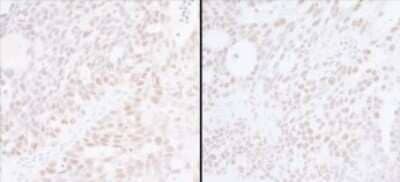 Immunohistochemistry: Spt6 Antibody [NB100-2583] - Samples: FFPE serial sections of human ovarian carcinoma Antibody: Affinity purified rabbit anti- SUPT6H A 300-802A-1 used at a dilution of 0.4ug/ml (left) and used at a dilution of 0.2ug/ml (right) . Detection: DAB