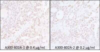 Immunohistochemistry: Spt6 Antibody [NB100-2583] - Samples: FFPE serial sections of human ovarian carcinoma Antibody: Affinity purified rabbit anti- SUPT6H A 300-802A-1 used at a dilution of 0.4ug/ml (left) and used at a dilution of 0.2ug/ml (right). Detection: DAB