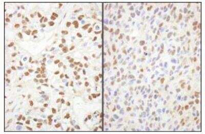 Immunohistochemistry-Paraffin: Spt6 Antibody [NB100-2583] - Sections of human breast carcinoma (left) and mouse squamous cell carcinoma (right).