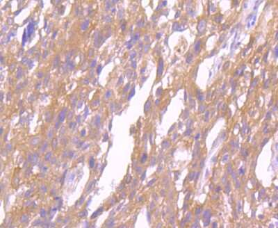Immunohistochemistry-Paraffin: Src Antibody (JF0947) [NBP2-67167] - Analysis of paraffin-embedded human breast carcinoma tissue using anti-Src antibody. Counter stained with hematoxylin.