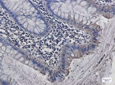 Immunohistochemistry-Paraffin: Src Antibody (S05-7H8) [NBP3-20055] - Immunohistochemistry of Src in paraffin-embedded Human colon cancer tissue using NBP3-20055 at dilution 1/50