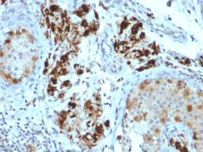 Immunohistochemistry-Paraffin: StAR Antibody (STAR/2154) - Azide and BSA Free [NBP2-75742] - Formalin-fixed, paraffin-embedded human Testicular Carcinoma stained with StAR Mouse Monoclonal Antibody (STAR/2154).