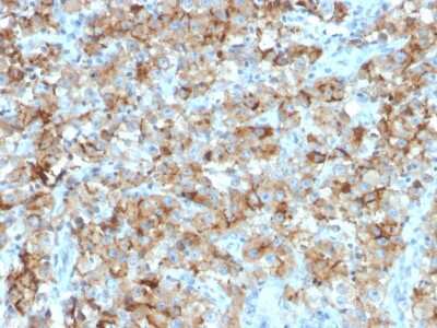 Immunohistochemistry-Paraffin: StAR Antibody (STAR/2154) - Azide and BSA Free [NBP2-75742] - Formalin-fixed, paraffin-embedded human Testicular Carcinoma stained with StAR Mouse Monoclonal Antibody (STAR/2154).