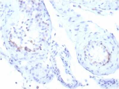 Immunohistochemistry-Paraffin: StAR Antibody (STAR/3915R) [NBP3-13786] - Formalin-fixed, paraffin-embedded human testicular carcinoma stained with StAR antibody (STAR/3915R). HIER: Tris/EDTA, pH9.0, 45min. HRP-polymer, 30min. DAB, 5min.