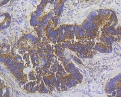 Immunohistochemistry: Stathmin 1 Antibody (11E1) [NBP2-76906] - Immunohistochemical analysis of paraffin-embedded human colon tissue using anti-Stathmin 1 antibody. The section was pre-treated using heat mediated antigen retrieval with Tris-EDTA buffer (pH 8.0-8.4) for 20 minutes.The tissues were blocked in 5% BSA for 30 minutes at room temperature, washed with ddH2O and PBS, and then probed with the antibody at 1/200 dilution, for 30 minutes at room temperature and detected using an HRP conjugated compact polymer system. DAB was used as the chrogen. Counter stained with hematoxylin and mounted with DPX.