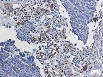 Immunohistochemistry-Paraffin: Staufen Antibody (S03-3G2) [NBP3-14978] - Immunohistochemistry of Staufen in paraffin-embedded Human breast cancer tissue using Staufen Rabbit mAb at dilution 1/50