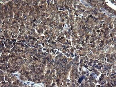 Immunohistochemistry: Sterol carrier protein 2 Antibody (OTI1E4) - Azide and BSA Free [NBP2-74401] - Analysis of Adenocarcinoma of Human endometrium tissue. (Heat-induced epitope retrieval by 1 mM EDTA in 10mM Tris, pH8.5, 120C for 3min)