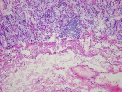 Hematoxylin & Eosin Stain: Stomach Matched Tumor & Normal Tissue Slides (Tumor) [NBP2-77668] - Tissue: Human Stomach,  Pathology: Adjacent normal tissue