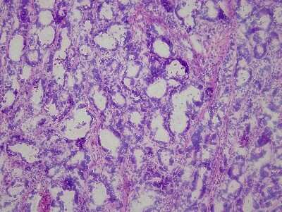 Hematoxylin & Eosin Stain: Stomach Matched Tumor & Normal Tissue Slides (Tumor) [NBP2-77668] - Tissue: Human Stomach Tumor,  Pathology: Primary Tumor