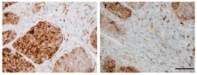 Immunohistochemistry: Sulfatase-2/SULF2 Antibody (2B4) - Azide and BSA Free [NBP2-80967] - Immunohistochemical analysis of Sulfatase 2 in non-small-cell lung carcinoma. (left) lung squamous cell carcinoma stained with 2B4 antibody and (right) tumor-associated stromal cells stained with 2B4 antibody. Image courtesy of Mark Singer at UCSF. Image