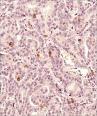 Immunohistochemistry-Paraffin: Survivin Antibody (1277A) - Azide and BSA Free [NBP2-80971] - Analysis of a formalin-fixed paraffin-embedded (FFPE) human prostate cancer tissue with rabbit monoclonal Survivin Antibody [NBP2-59503] at 2 ug/ml concentration. The staining was developed with HRP-DAB detection method and the sections were counterstaine