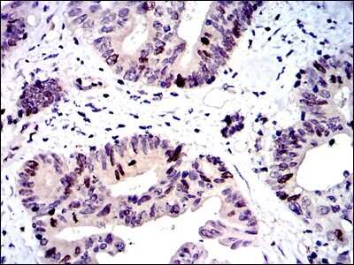 Immunohistochemistry-Paraffin: Survivin Antibody (1H5) [NBP2-22188] - Immunohistochemical analysis of paraffin-embedded colon cancer tissues using mouse monoclonal Survivin Antibody (1H5) [NBP2-22188] with DAB staining.