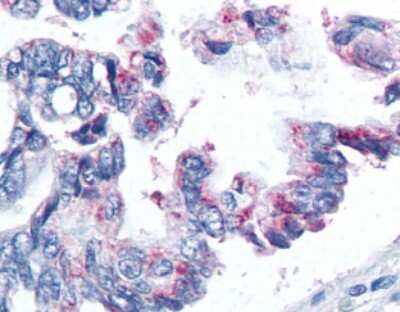 Immunohistochemistry-Paraffin: Survivin Antibody (32.1) - Azide and BSA Free [NBP2-80968] - Immunohistochemical staining of formalin-fixed paraffin-embedded human lung cancer tissue using Survivin Antibody (32.1) [NB500-237]. Image from the standard format of this antibody.