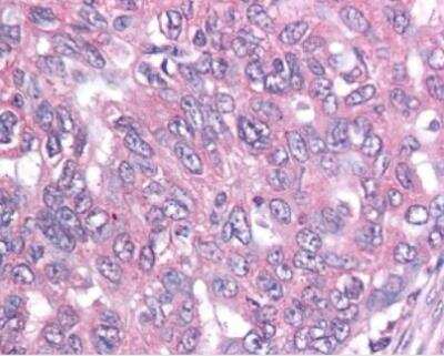 Immunohistochemistry-Paraffin: Survivin Antibody (60.11) - Unpurified [NB500-205] - Immunohistochemical staining of formalin-fixed paraffin-embedded ovarian cancer tissue using Survivin Antibody (60.11) - Unpurified [NB500-205].