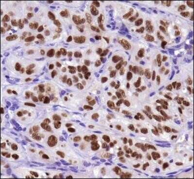 Immunohistochemistry: Survivin Antibody (8E2) - Azide and BSA Free [NBP2-80970] - Immunohistochemical analysis of Survivin in human breast cancer tissue using Survivin Antibody (8E2) [NB500-644] and DAB with hematoxylin counterstain. Image from the standard format of this antibody.