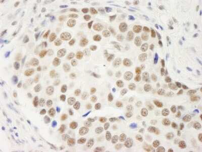 <b>Independent Antibodies Validation. </b>Immunohistochemistry-Paraffin: Symplekin Antibody [NB100-74592] - Sample: FFPE section of human breast carcinoma. Antibody: Affinity purified rabbit anti- Symplekin used at a dilution of 1:200 (1ug/ml). Detection: DAB
