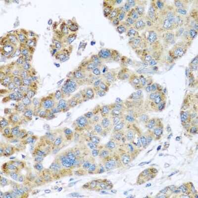 Immunohistochemistry-Paraffin: Synaptotagmin 4 Antibody [NBP2-93411] - Paraffin-embedded human liver cancer using Synaptotagmin 4 .