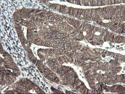 Immunohistochemistry: Synaptotagmin 4 Antibody (OTI4H3) - Azide and BSA Free [NBP2-74415] - Analysis of Adenocarcinoma of Human endometrium tissue. (Heat-induced epitope retrieval by 10mM citric buffer, pH6.0, 120C for 3min)