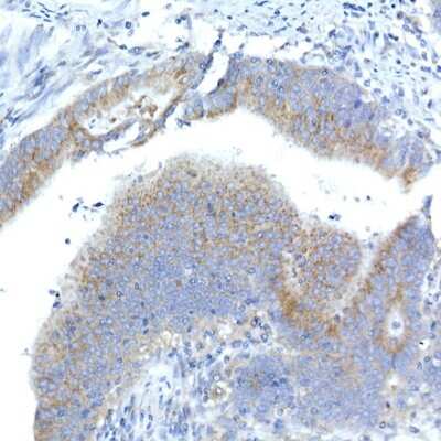 Immunohistochemistry-Paraffin: Syntaxin 16 Antibody (5H6D5) [NBP3-16810] - Immunohistochemistry of paraffin-embedded human colon carcinoma using Syntaxin 16 Rabbit mAb (NBP3-16810) at dilution of 1:50 (40x lens).Perform high pressure antigen retrieval with 10 mM citrate buffer pH 6.0 before commencing with IHC staining protocol.