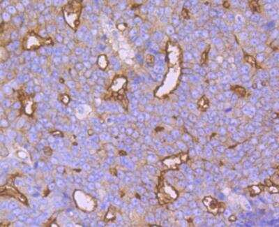 Immunohistochemistry: Syntaxin 3 Antibody (JE40-96) [NBP2-76872] - Immunohistochemical analysis of paraffin-embedded human prostate cancer tissue using anti-Syntaxin 3 antibody. Counter stained with hematoxylin.