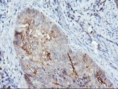Immunohistochemistry: Syntenin 1 Antibody (OTI2H6) - Azide and BSA Free [NBP2-74418] - Staining of paraffin-embedded Adenocarcinoma of Human endometrium tissue using anti-Syntenin 1 mouse monoclonal antibody.