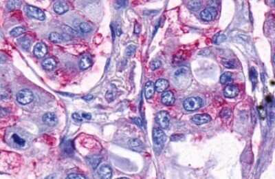 Immunohistochemistry-Paraffin: TAAR9 Antibody [NLS1969] - Anti-TAAR9 antibody IHC of human Lung, Adenocarcinoma. Immunohistochemistry of formalin-fixed, paraffin-embedded tissue after heat-induced antigen retrieval.