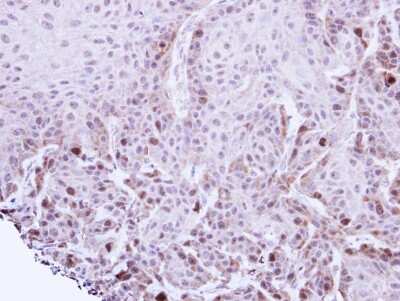 Immunohistochemistry-Paraffin: TACC2 Antibody [NBP1-31221] -  Cal27 xenograft, using TACC2 antibody at 1:100 dilution. Antigen Retrieval: Citrate buffer, pH 6.0, 15 min.