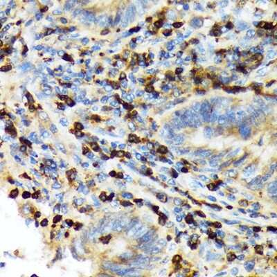 Immunohistochemistry-Paraffin: TACC3 Antibody (7S7L2) [NBP3-15816] - Immunohistochemistry of paraffin-embedded human colon carcinoma using TACC3 Rabbit mAb (NBP3-15816) at dilution of 1:100 (40x lens).Perform microwave antigen retrieval with 10 mM Tris/EDTA buffer pH 9.0 before commencing with IHC staining protocol.
