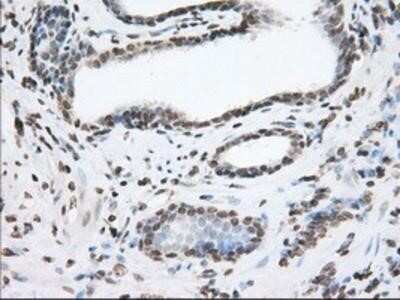 Immunohistochemistry: TACC3 Antibody (OTI6F1) - Azide and BSA Free [NBP2-74436] - Staining of paraffin-embedded Carcinoma of Human prostate tissue using anti-TACC3 mouse monoclonal antibody.