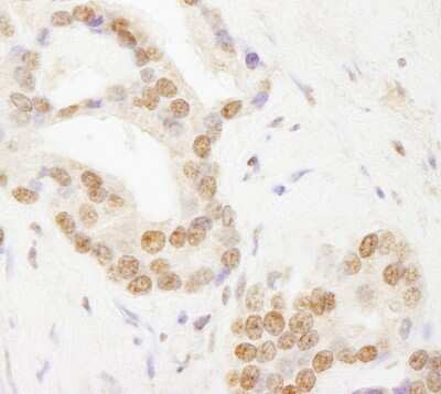 <b>Independent Antibodies Validation and Biological Strategies Validation.</b>Immunohistochemistry-Paraffin: TAF6 Antibody [NB100-60640] - Section of human prostate carcinoma. Antibody: Affinity purified rabbit anti- TAF6 used at a dilution of 1:200 (1ug/ml). Detection: DAB