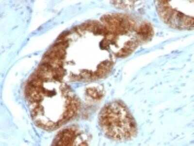 Immunohistochemistry-Paraffin: TAG-72 Antibody (B72.3 + CA72/733) - IHC-Prediluted [NBP2-45178] - Formalin-fixed. paraffin-embedded human Prostate carcinoma stained with TAG-72 Monoclonal Antibody (B72.3+CA72/733)