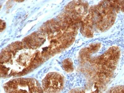 Immunohistochemistry-Paraffin: TAG-72 Antibody (B72.3 + CC49) - Azide and BSA Free [NBP2-34558] - Formalin-paraffin human Prostate Carcinoma stained with TAG-72 MAb (B72.3 + CC49).