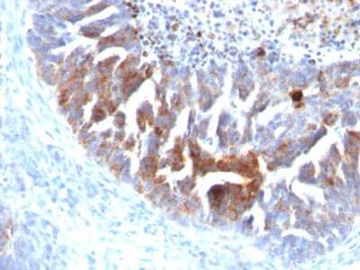 Immunohistochemistry-Paraffin: TAG-72 Antibody (B72.3 + CC49) - Azide and BSA Free [NBP2-34558] - Formalin-paraffin human Ovarian Carcinoma stained with TAG-72 MAb (B72.3 + CC49).